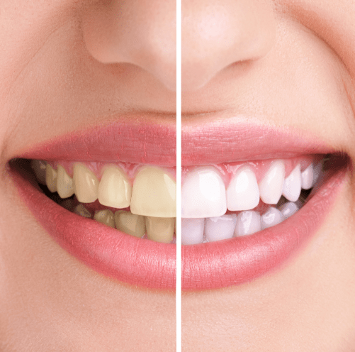 Teeth Whitening | Core Dental | General & Family Dentist | Downtown Calgary