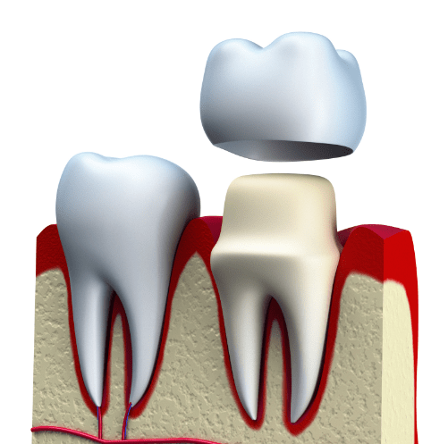 Dental Crowns | Core Dental | General & Family Dentist | Downtown Calgary