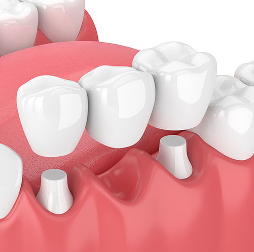 Dental Bridges | Core Dental | General & Family Dentist | Downtown Calgary