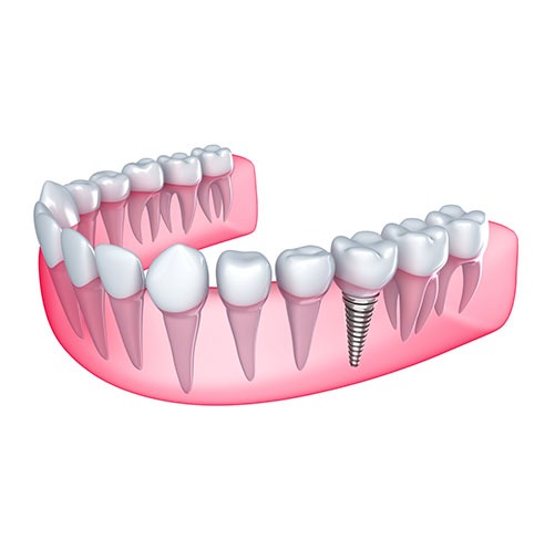 Dental Implants | Core Dental | General & Family Dentist | Downtown Calgary