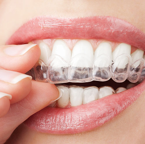 Invisalign® | Core Dental | General & Family Dentist | Downtown Calgary