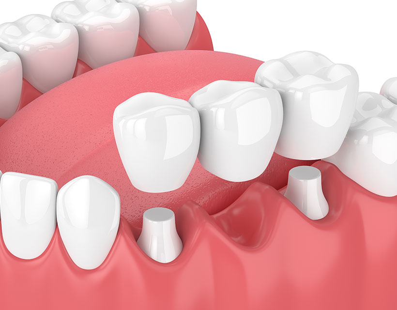 Dental Bridges | Core Dental | General & Family Dentist | Downtown Calgary