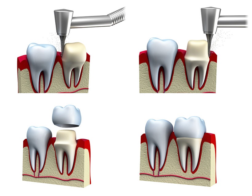 Calgary Dental Crowns | Core Dental | General & Family Dentist | Downtown Calgary