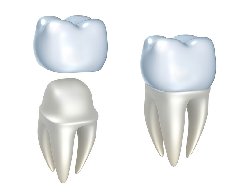 Dental Crowns Calgary | Core Dental | General & Family Dentist | Downtown Calgary