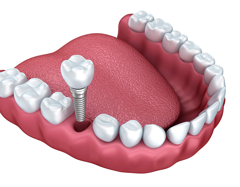 Dental Implant | Core Dental | General & Family Dentist | Downtown Calgary
