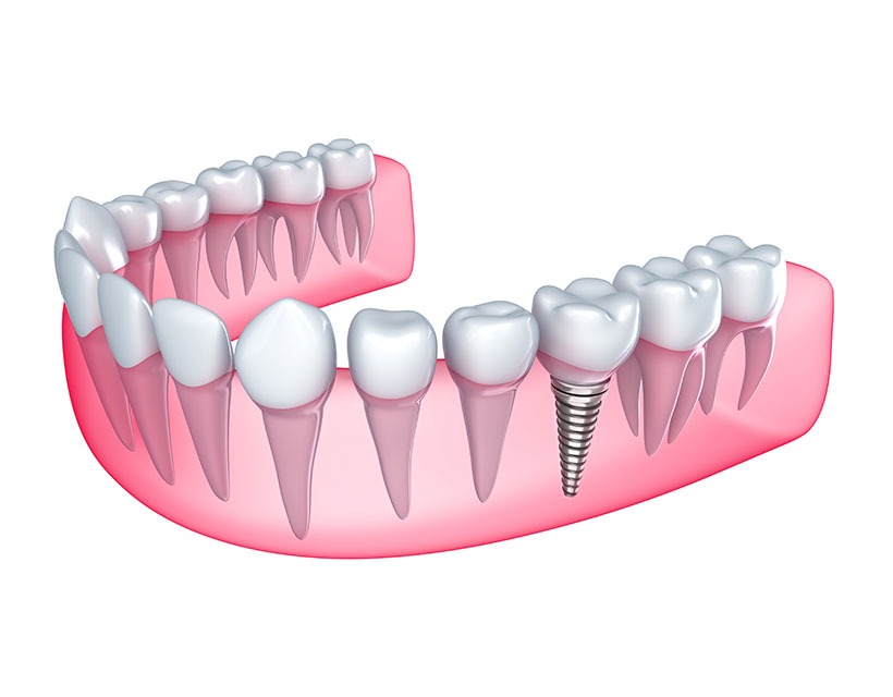 Dental Implants | Core Dental | General & Family Dentist | Downtown Calgary