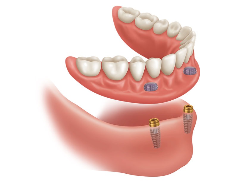 Implant Supported Dentures | Core Dental | General & Family Dentist | Downtown Calgary