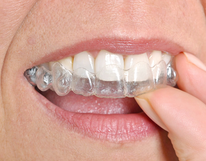 Orthodontics | Invisalign® | Core Dental | General & Family Dentist | Downtown Calgary